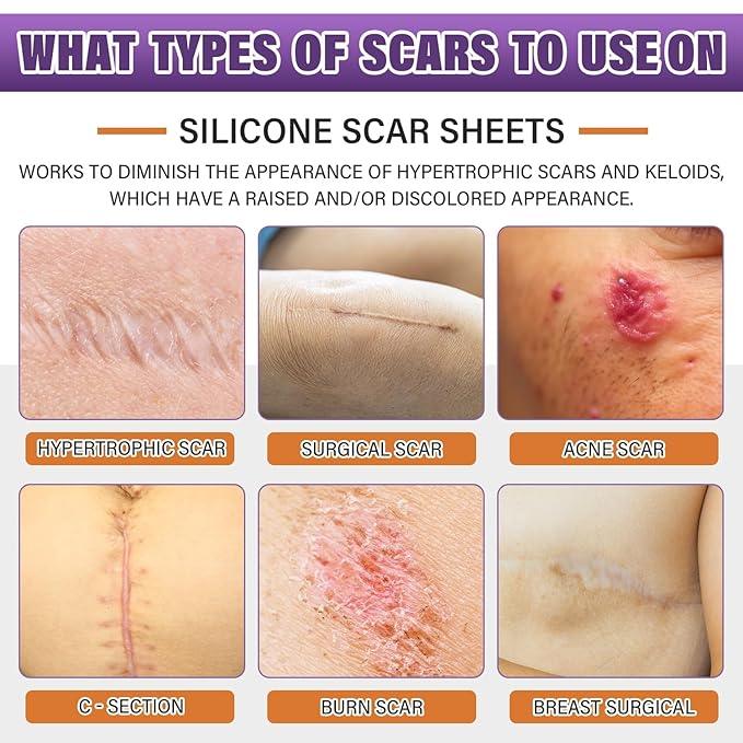 Dermacure™ Silicone Scar Tape